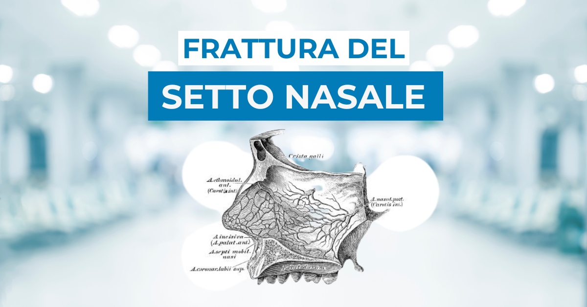 Frattura del setto nasale: cos’è, come curarla, tempi di recupero